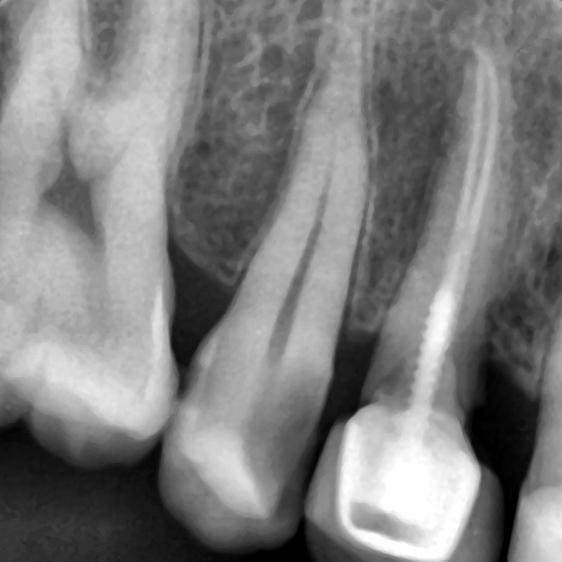 Bondent Bondream Sensor - Dental Intraoral Digital Sensor