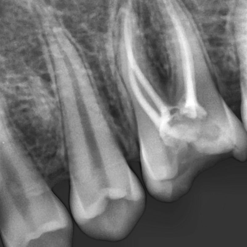 Bondent Bondream Air - Dental Portable Dental X-ray Device